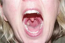 Bademcik İltihabı Bitkisel Tedavi