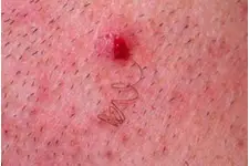 Ter Bezi İltihabı Belirtileri ve Tedavisi