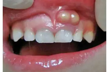 Diş Eti İltihabı Bitkisel Çözüm