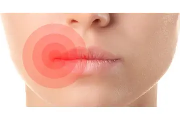 Dudak İltihabı Belirtileri ve Tedavisi