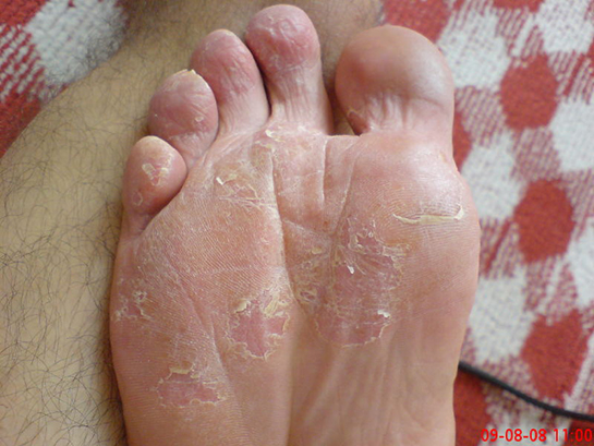 Ayakta İltihap Belirtileri ve Tedavisi