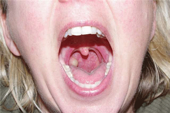 Bademcik İltihabı Bitkisel Tedavi