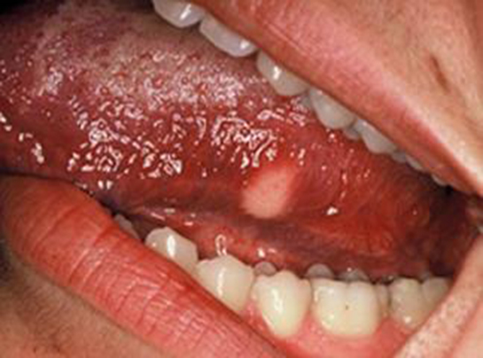 Dil İltihabı Belirtileri ve Tedavisi