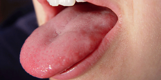 Dil Kökü İltihabı Belirtileri ve Tedavisi