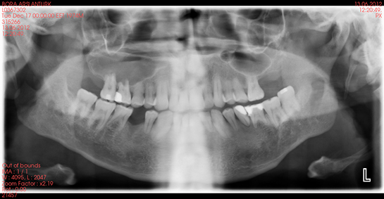 Diş Kökü İltihabı Belirtileri ve Tedavisi
