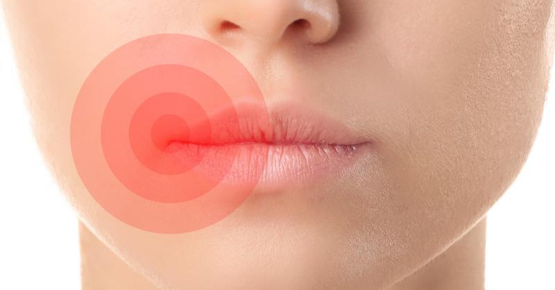 Dudak İltihabı Belirtileri ve Tedavisi