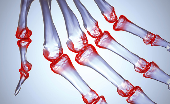 Eklem İltihabı Belirtileri ve Tedavisi