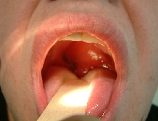 Gırtlak İltihabı Belirtileri ve Tedavisi