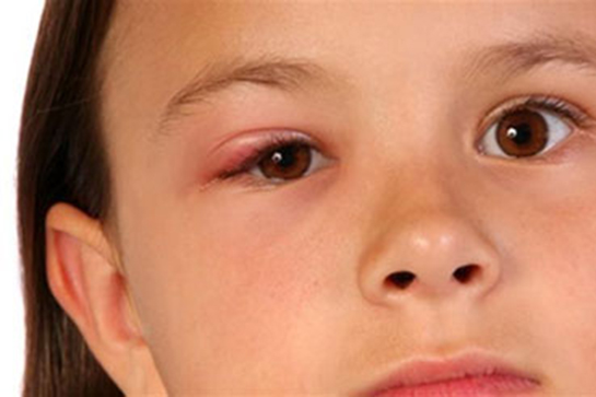 Göz Kapağı İltihabı Belirtileri ve Tedavisi