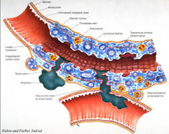 Kalın Bağırsak İltihabı Belirtileri ve Tedavisi