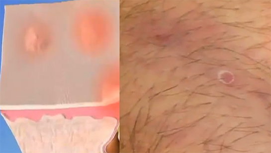 Kasıkta Kıl Kökü İltihabı Belirtileri ve Tedavisi