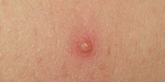 Kıl Kökü İltihabı Belirtileri ve Tedavisi