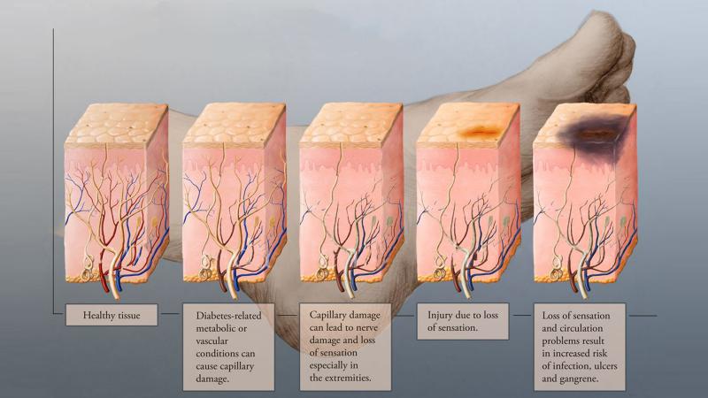 Sinir Ucu İltihabı Belirtileri ve Tedavisi
