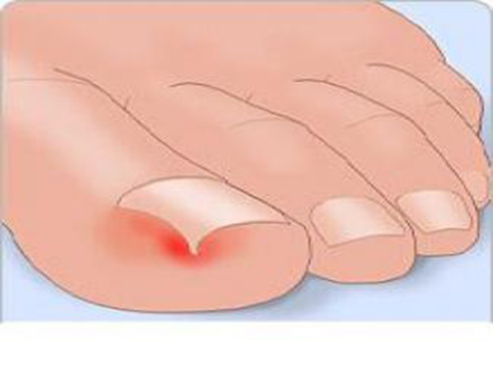 Tırnak İltihabı Belirtileri ve Tedavisi