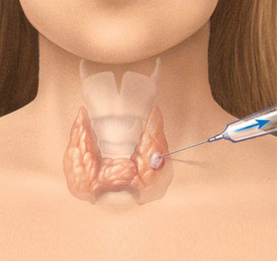 Tiroid İltihabı Belirtileri ve Tedavisi