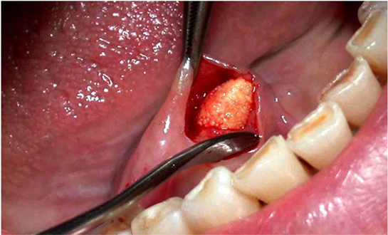 Tükürük Bezi İltihabı Belirtileri ve Tedavisi