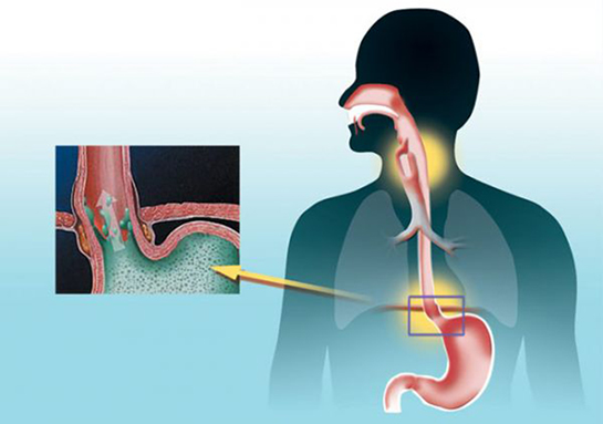 Yemek Borusu İltihabı Belirtileri ve Tedavisi