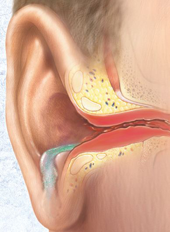 Yetişkinlerde Orta Kulak İltihabı Belirtileri ve Tedavisi