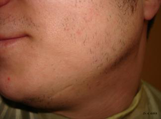 Yüzde Kıl Kökü İltihabı Belirtileri ve Tedavisi